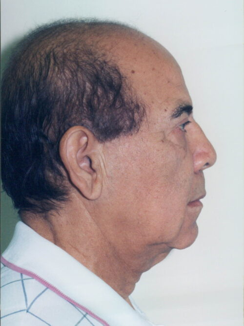 Male Facelift Patient 26 - Before - 1