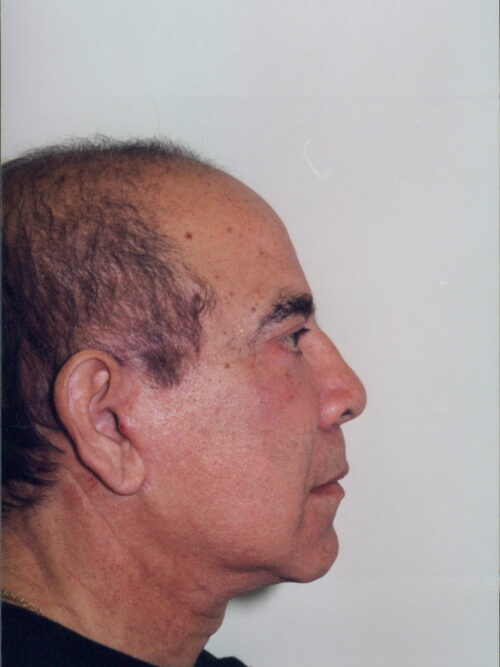 Male Facelift Patient 26 - After - 1