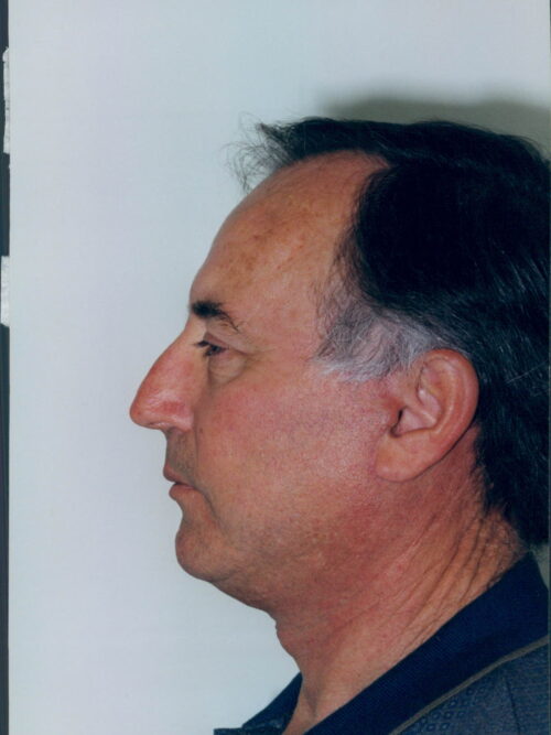 Male Facelift Patient 24 - After - 1