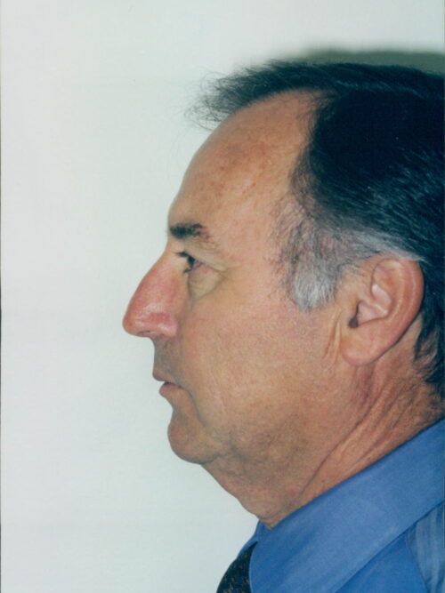 Male Facelift Patient 24 - Before - 1