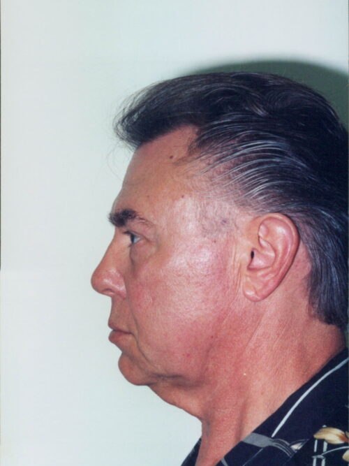 Male Facelift Patient 21 - Before - 2