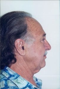 Male Facelift Patient 20 - Before - 2 Thumbnail