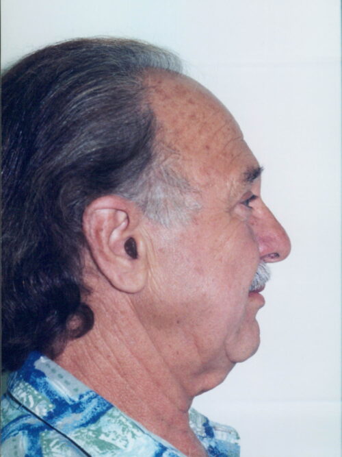 Male Facelift Patient 20 - Before - 2