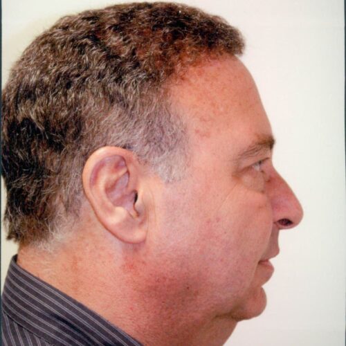 Male Facelift Patient 04 - Before - 2