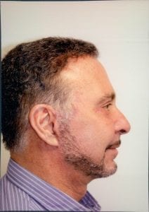 Male Facelift Patient 04 - After - 2 Thumbnail