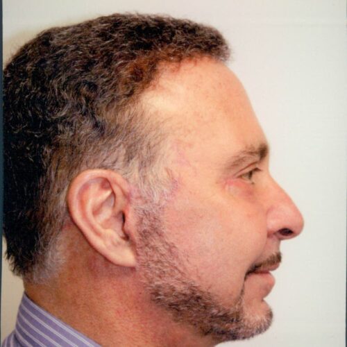 Male Facelift Patient 04 - After - 2