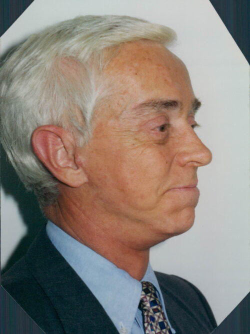 Male Facelift Patient 16 - After - 1