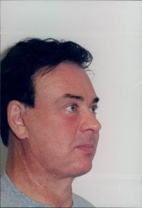 Male Facelift Patient 15 - After - 1 Thumbnail