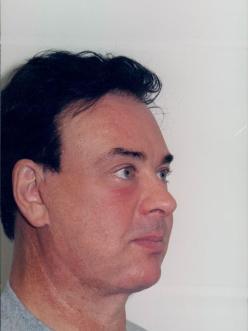 Male Facelift Patient 15 - After - 1