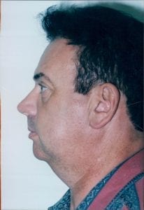 Male Facelift Patient 15 - Before - 2 Thumbnail