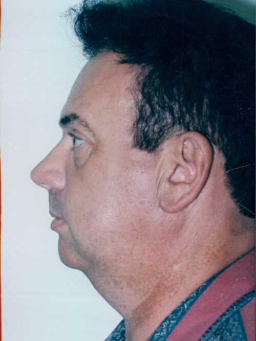 Male Facelift Patient 15 - Before - 2