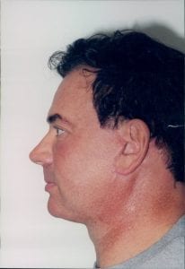 Male Facelift Patient 15 - After - 2 Thumbnail