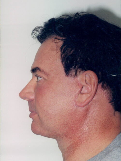 Male Facelift Patient 15 - After - 2