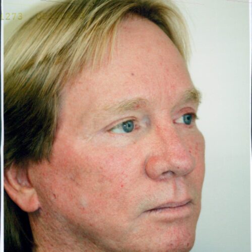 Male Facelift Patient 11 - After - 1