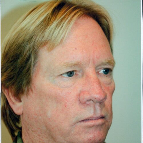 Male Facelift Patient 11 - Before - 1