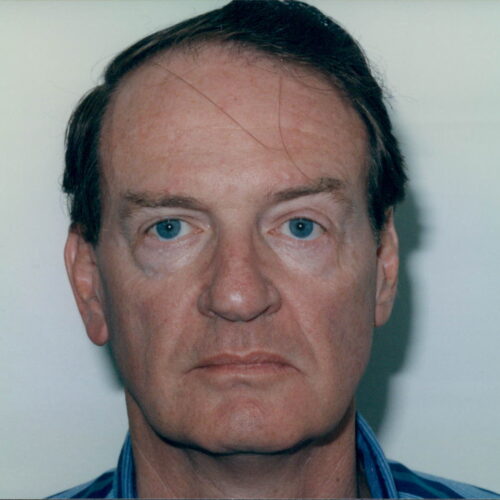 Male Facelift Patient 10 - Before - 1