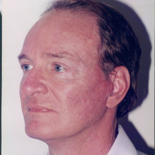 Male Facelift Patient 10 - After - 2