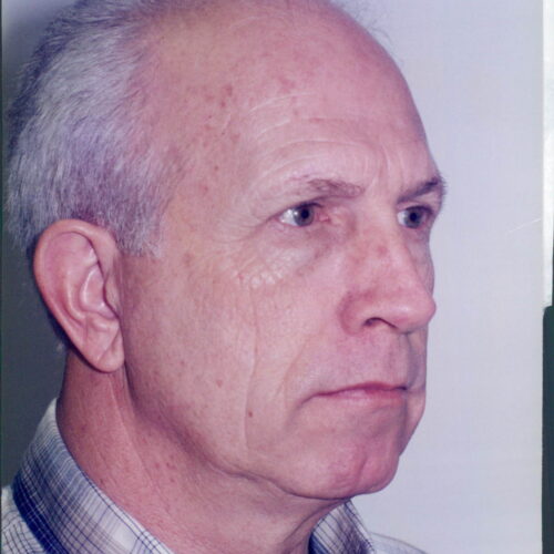 Male Facelift Patient 09 - Before - 2