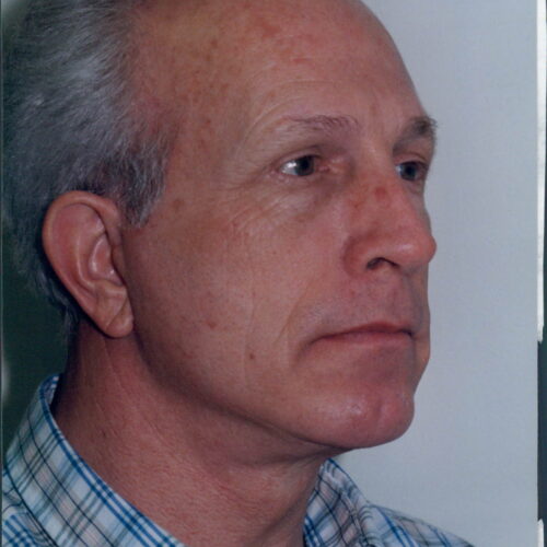 Male Facelift Patient 09 - After - 2