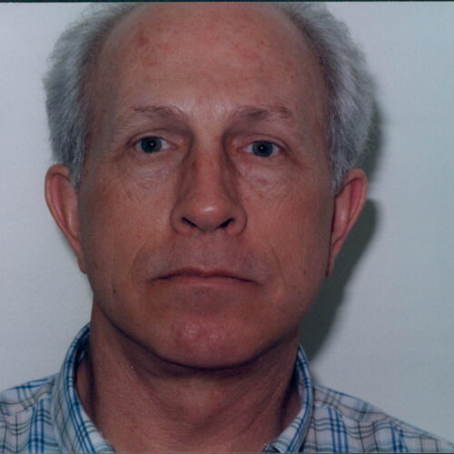 Male Facelift Patient 09 - After - 1