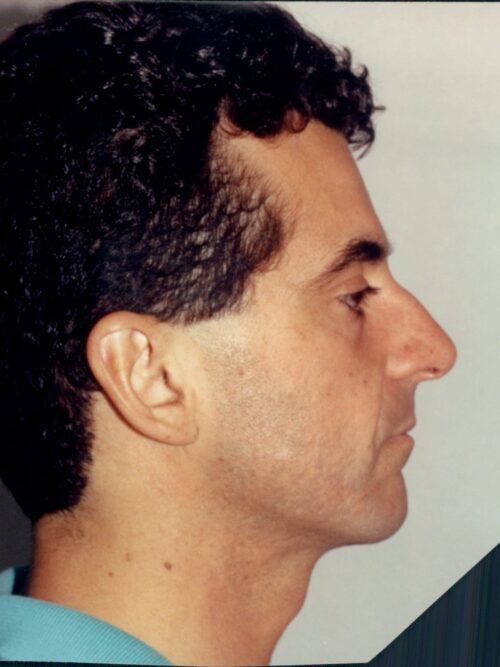 Male Rhinoplasty Patient 06 - Before - 1
