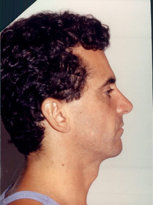 Male Rhinoplasty Patient 06 - After - 1