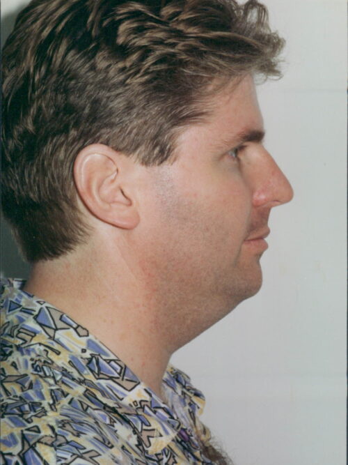Male Rhinoplasty Patient 05 - Before - 1