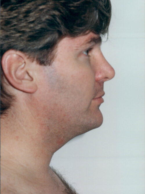 Male Rhinoplasty Patient 05 - After - 1