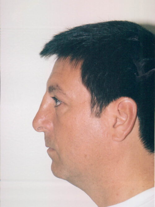 Male Rhinoplasty Patient 04 - Before - 1