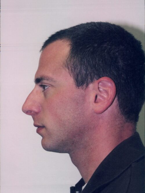 Male Rhinoplasty Patient 02 - Before - 1