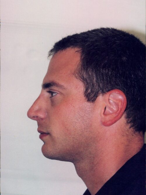 Male Rhinoplasty Patient 02 - After - 1