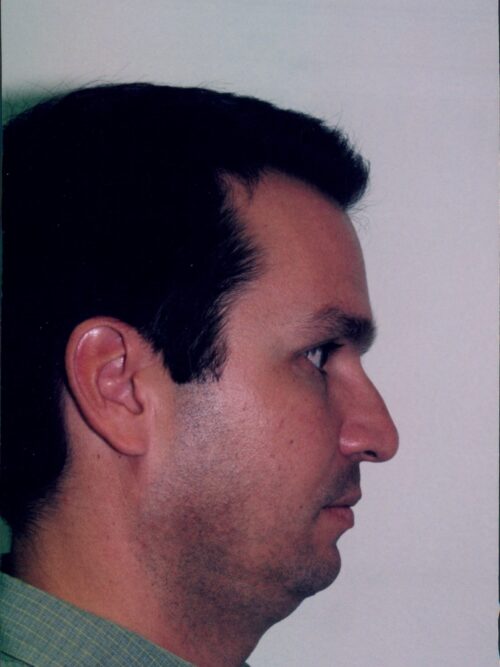 Male Rhinoplasty Patient 01 - Before - 1
