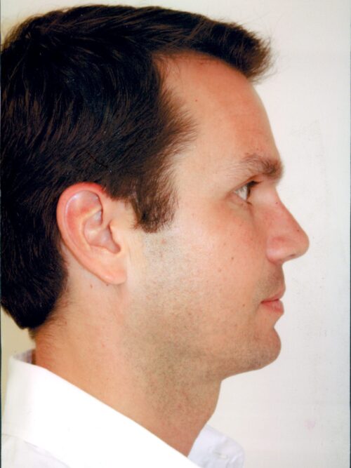 Male Rhinoplasty Patient 01 - After - 1