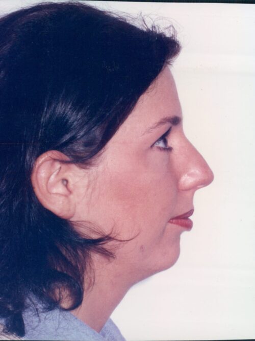 Rhinoplasty Patient 30 - Before - 1