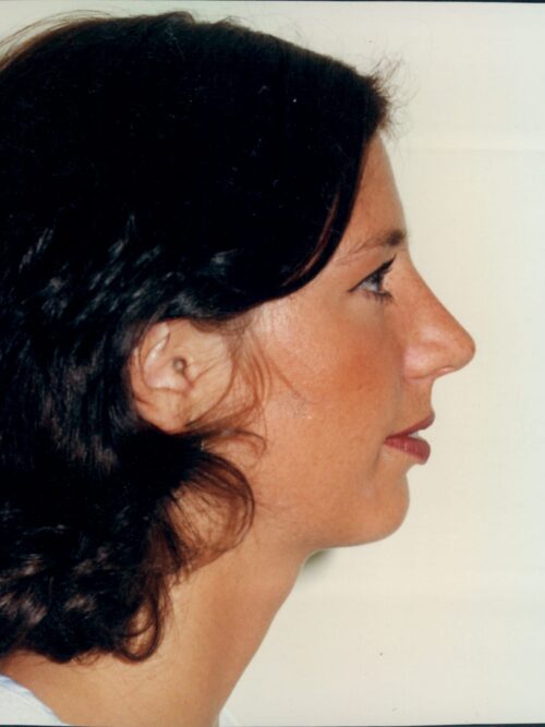 Rhinoplasty Patient 30 - After - 1