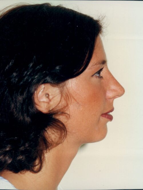 Rhinoplasty Patient 30 - After - 1