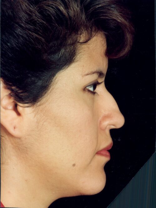 Rhinoplasty Patient 29 - Before - 1