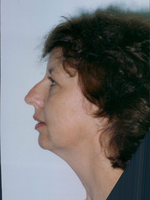 Rhinoplasty Patient 32 - Before - 1