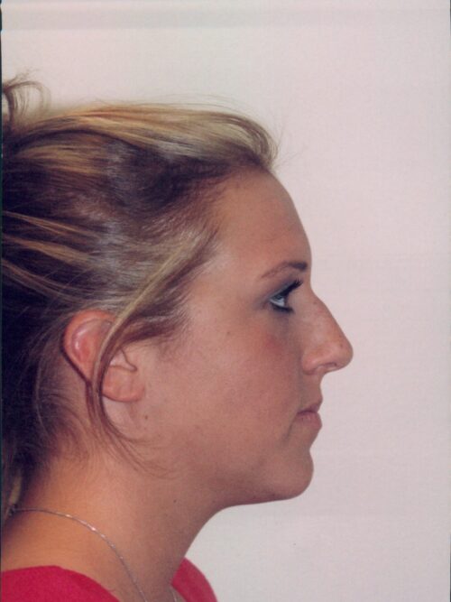 Rhinoplasty Patient 26 - Before - 1