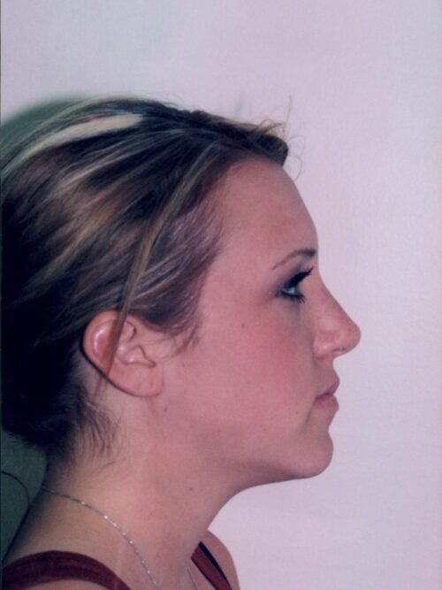 Rhinoplasty Patient 26 - After - 1