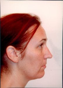 Rhinoplasty Patient 22 - Before - 2 Thumbnail