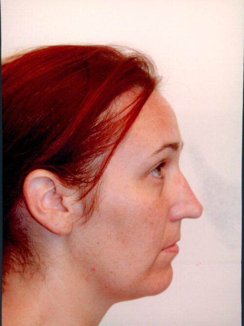Rhinoplasty Patient 22 - Before - 2