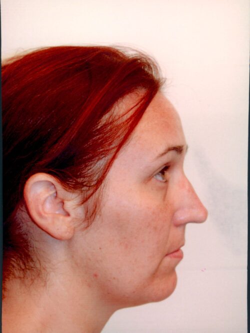 Rhinoplasty Patient 22 - Before - 2