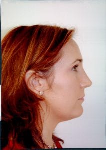 Rhinoplasty Patient 22 - After - 2 Thumbnail