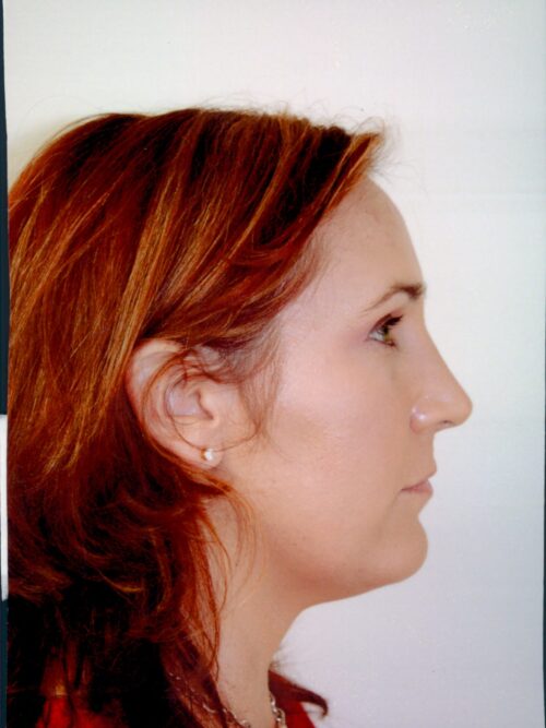 Rhinoplasty Patient 22 - After - 2