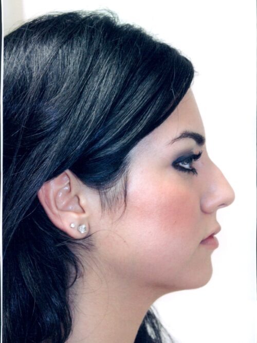 Rhinoplasty Patient 24 - Before - 1