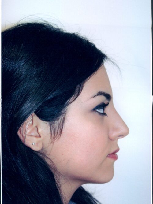 Rhinoplasty Patient 24 - After - 1