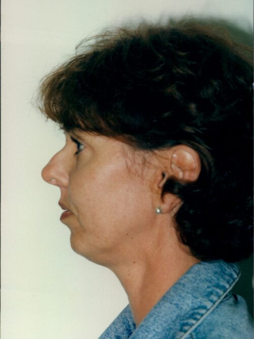 Rhinoplasty Patient 21 - Before - 1