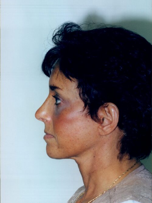 Rhinoplasty Patient 19 - After - 1