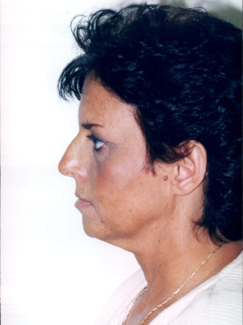 Rhinoplasty Patient 19 - Before - 1